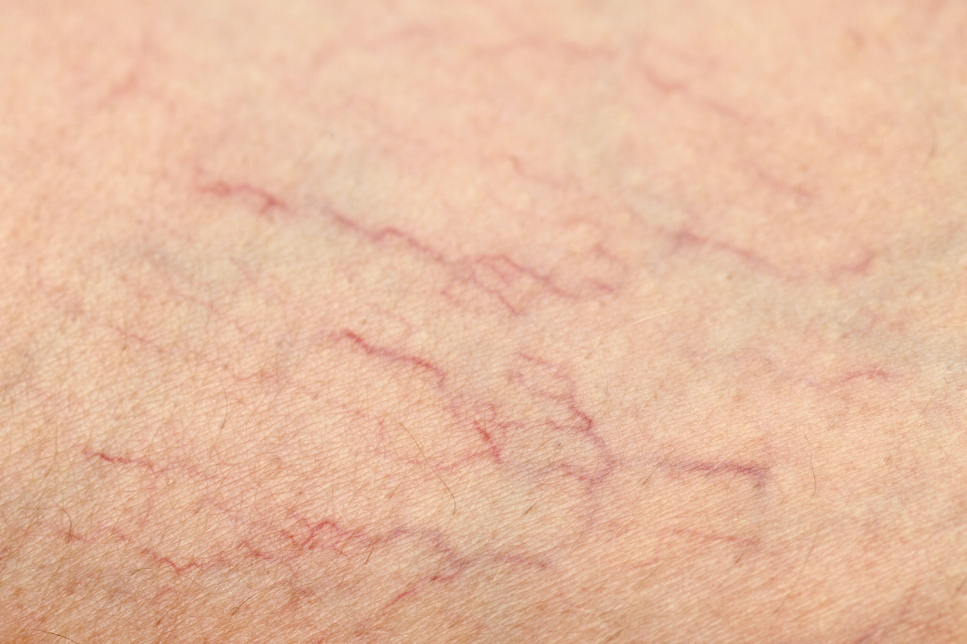Spider Vein di Wajah: Mengapa Pembuluh Darah Bisa Terlihat Seperti Jaring Laba-Laba?